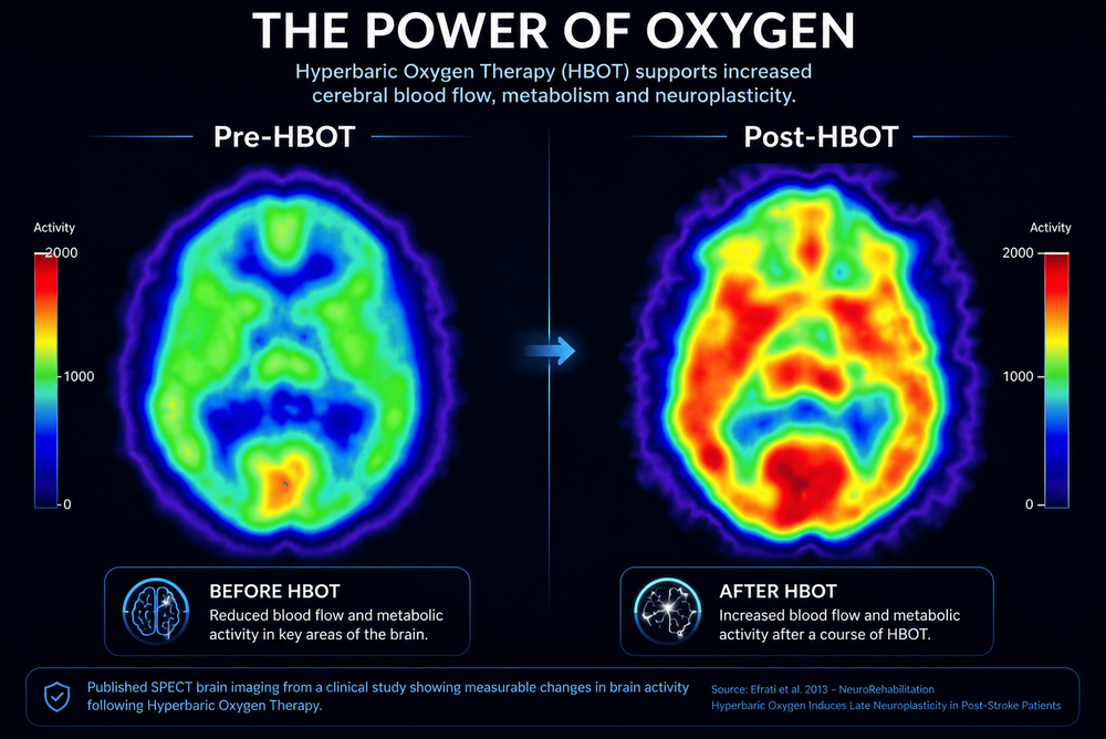 Brain scans before and after hyperbaric oxygen therapy