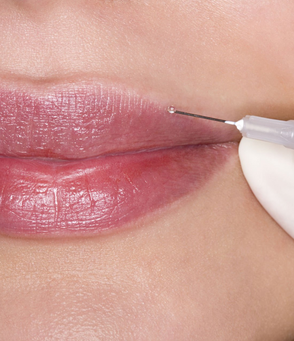Lip Fillers