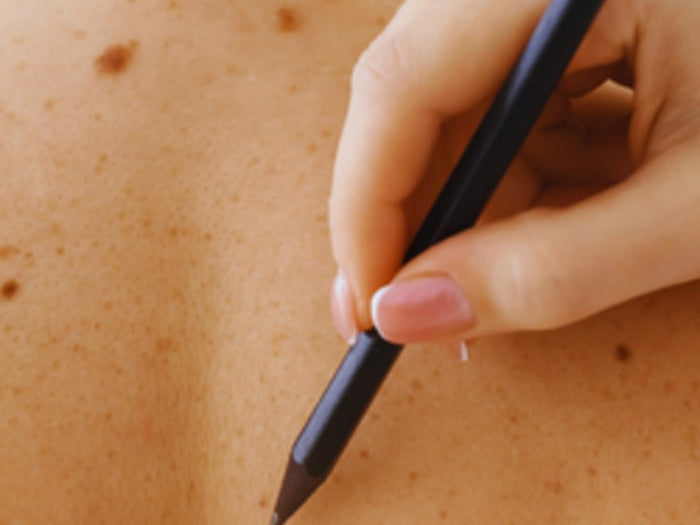 A practitioner marking a mole on the back